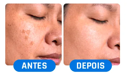Antes e depois: manchas no rosto