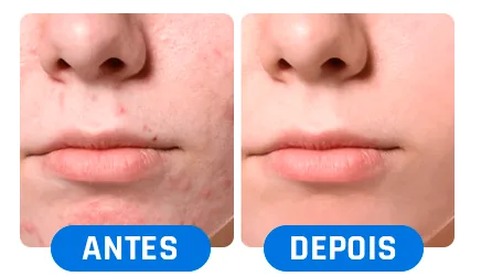 Antes e depois: pele do rosto
