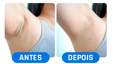 Antes e depois: axila